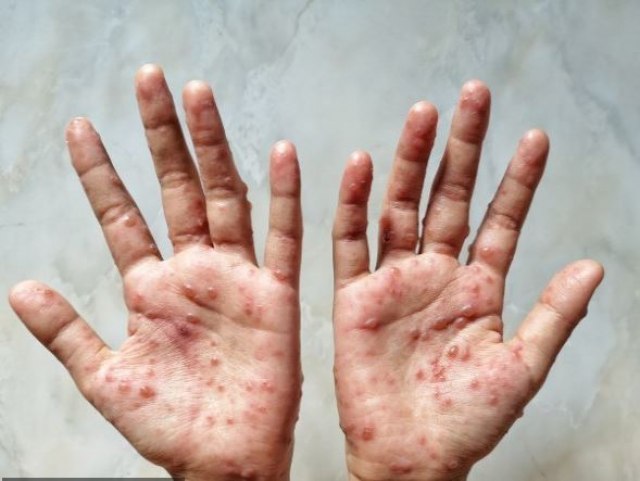 Majmunske boginje se šire Evropom: Hoće li biti epidemije?